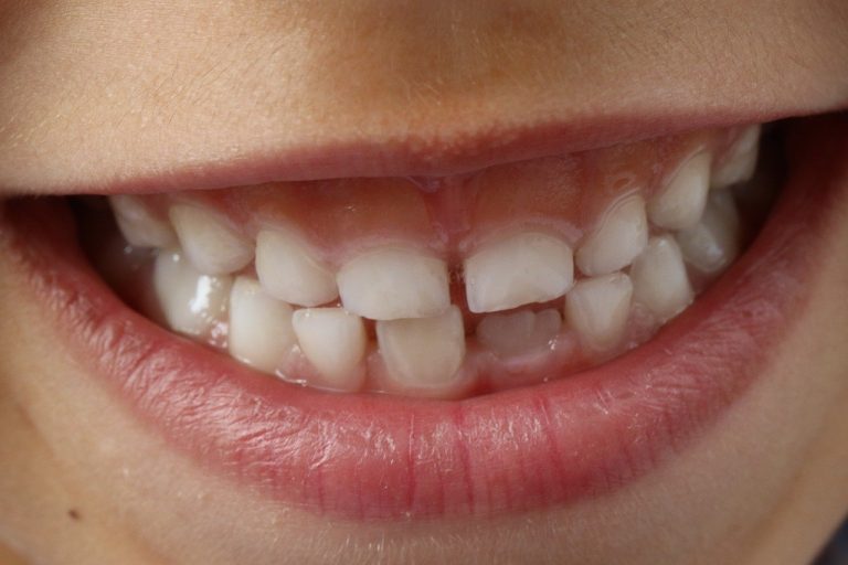 Les traitements orthodontiques préventifs pour les enfants